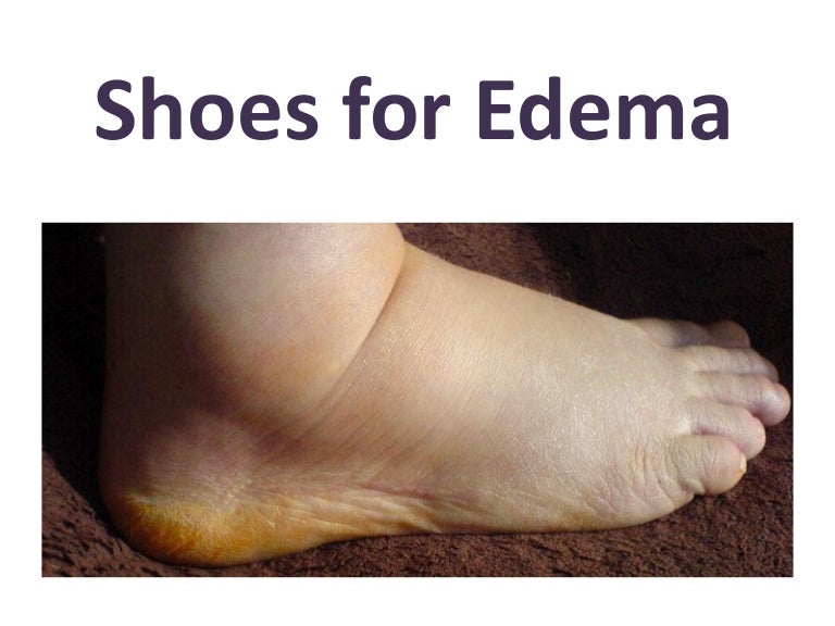 shoes for people with severe edema