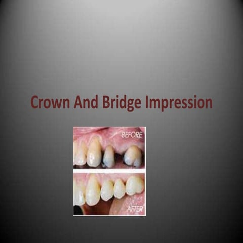 Crown and bridge impression slides