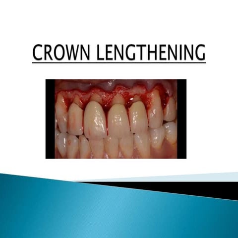 Crown lengthening