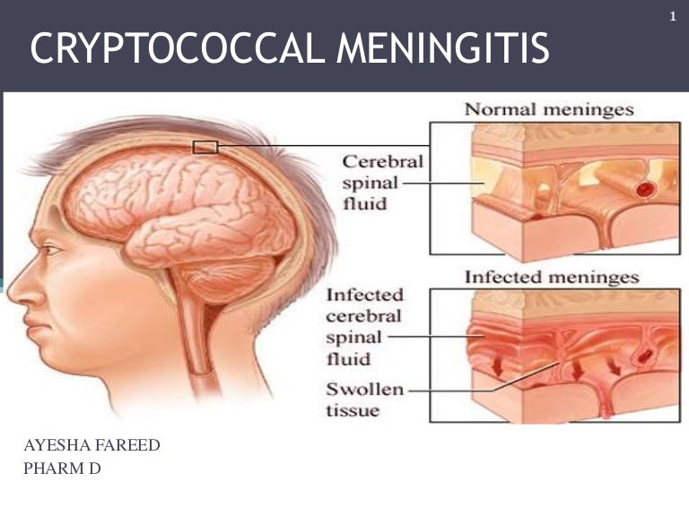 Cryptococcal Meningitis SEMINAR Cryptococcal Meningitis SEMINAR