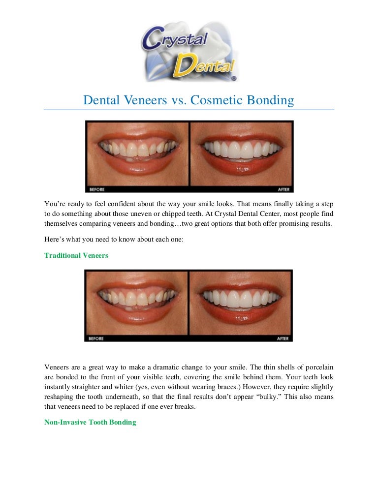 Dental Veneers vs. Cosmetic Bonding