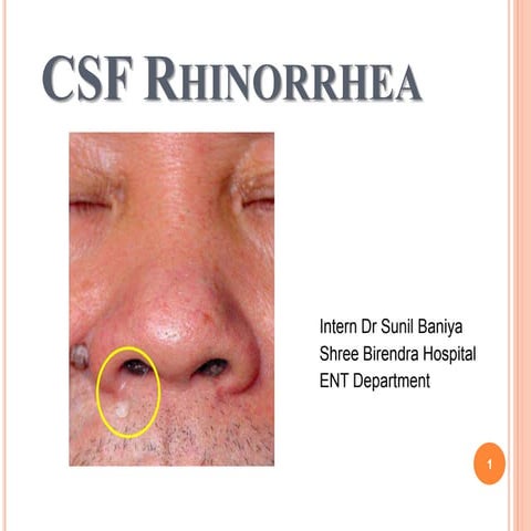 Csf Rhinorrhea - Overview