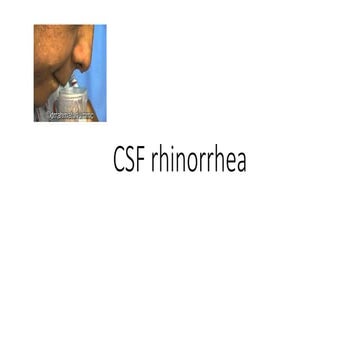 Csf rhinorrhea ppt 