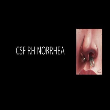 CSF rhinorrhea in Craniofacial Trauma[Autosaved].pptx