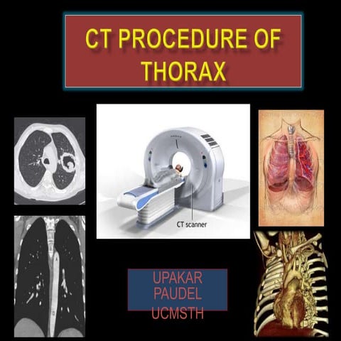 CT Procedure of Thorax (CT Chest)