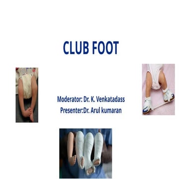 Club foot / CTEV | PDF