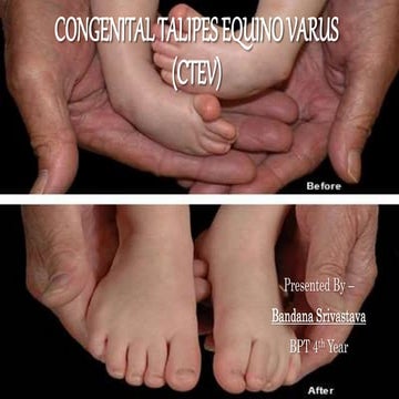 CONGENITAL TALIPES EQUINO VARUS (CTEV)