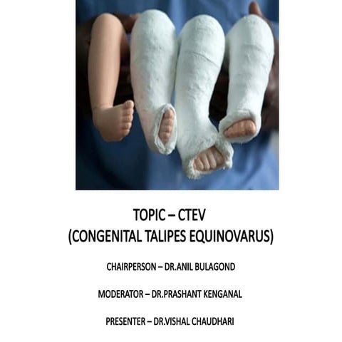 Club foot / CTEV | PDF