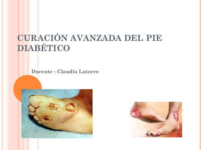 Cuidado avanzado de heridas pie diabetico