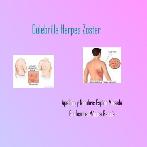 Culebrilla herpes zoster