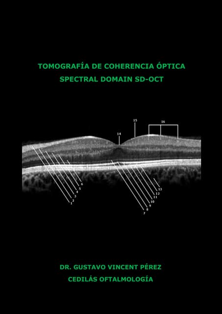 CURSO OCT SPECTRAL DOMAIN | PDF