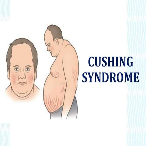 Cushing Syndrome