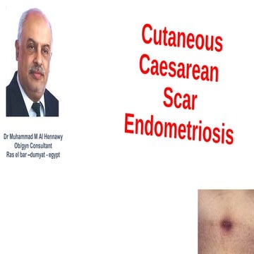 Cutaneous  cesarean  scar   endometriosis
