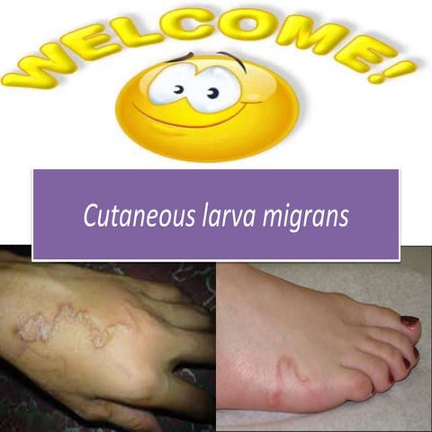 Cutaneous Larva Migrans | PPTX