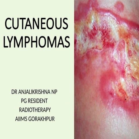 Cutaneous T Cell Lymphomas | PPTX