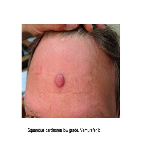 Ipilimumab and BRAF inhibitors cutaneous toxicity | PPT
