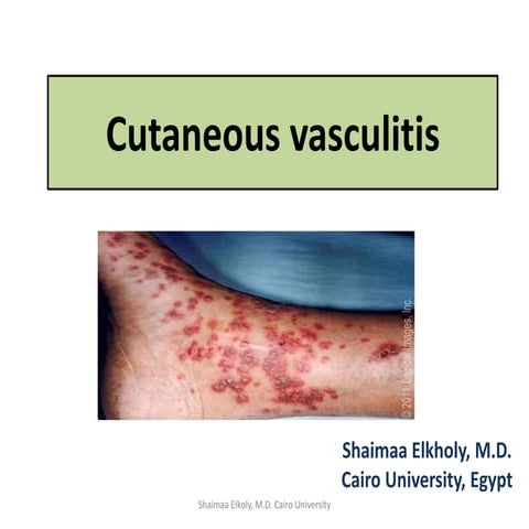 Cutaneous vasculitis