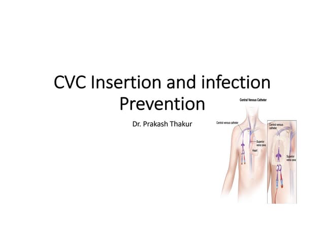 Temporary vascular access for hemodialysis | PPTX