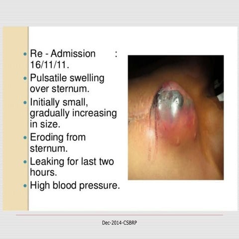 Cvs aneurysms&amp;dissection-csbrp