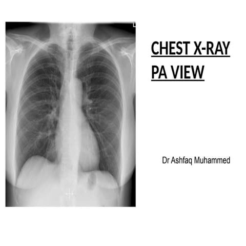 Comprehensive Guide to Chest X-Ray PA View Positioning and ...
