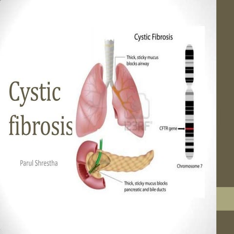 Cystic fibrosis | PPTX