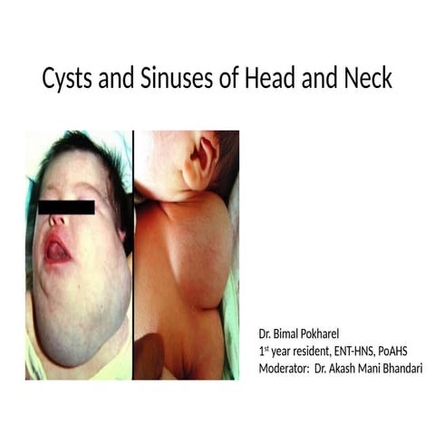 Cysts and sinus of neck in head and neck cancer..pptx