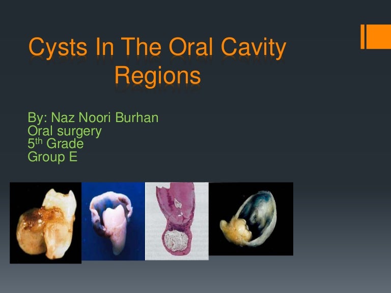 Cysts of oral regions