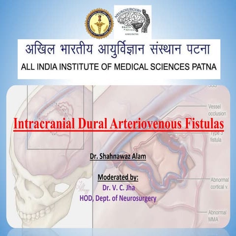 Dural arteriovenous fistula