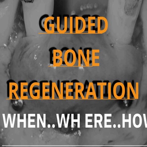 Guided bone regeneration in implantology and periodontology | PDF