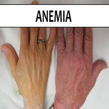 Approach to anemia 