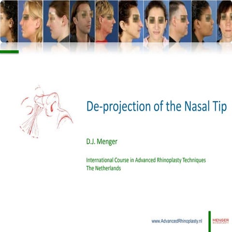 Rhinoplasty | PPTX