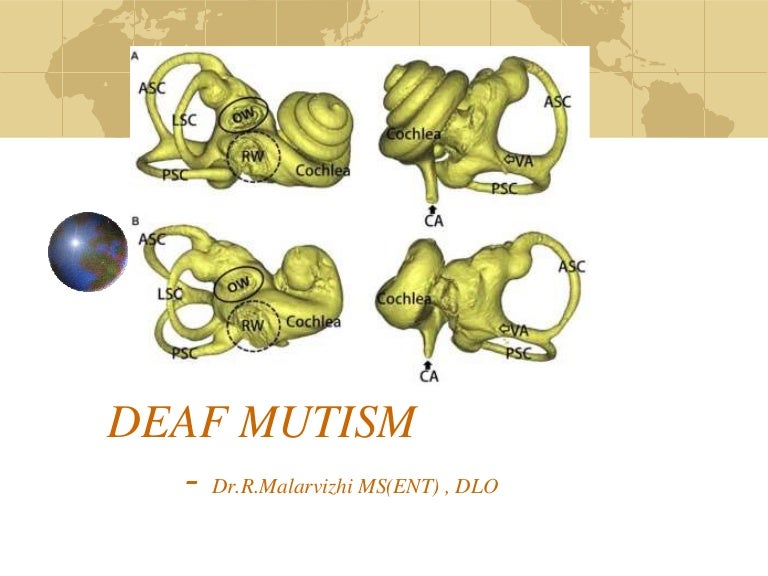 Deaf mutism