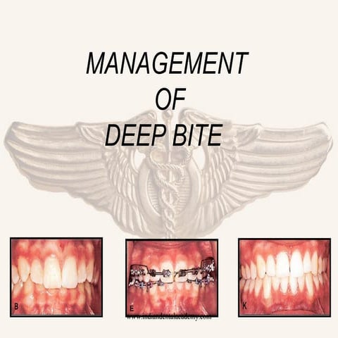 Management of Deepbite /certified fixed orthodontic courses by Indian dental ...