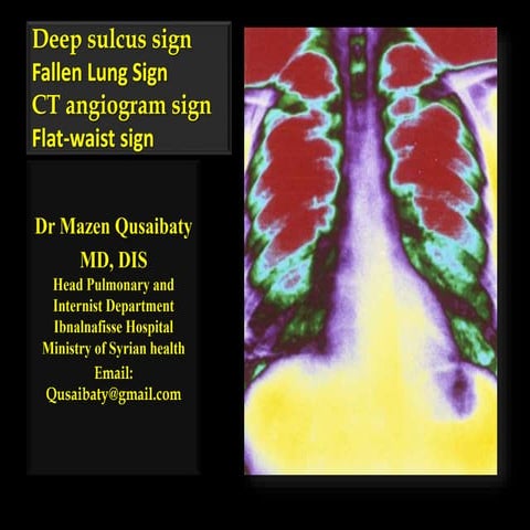 Deep sulcus sign fallen lung sign-ct angiogram sign-flat-waist sign