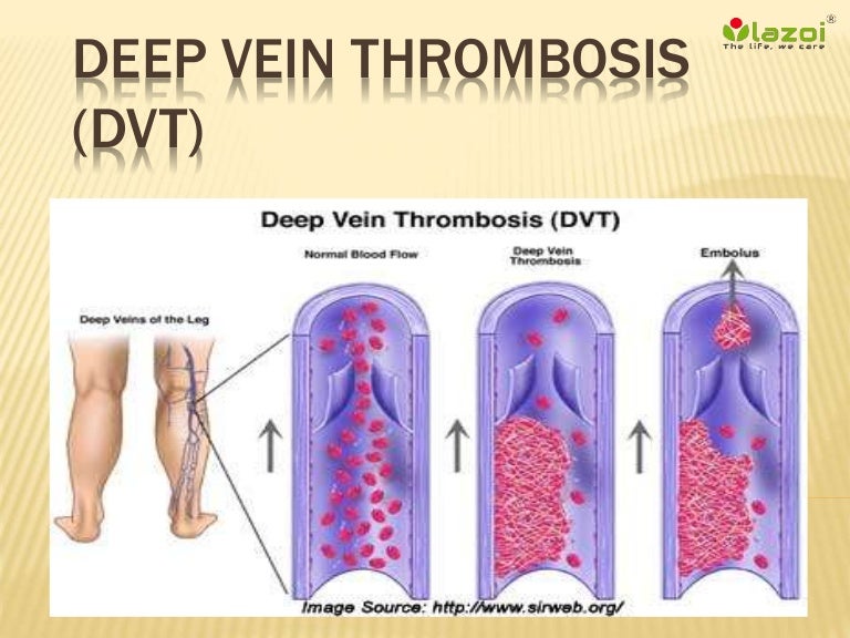 Deep vein thrombosis dvt