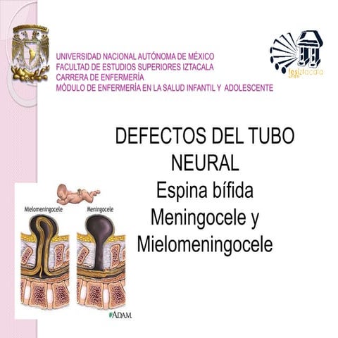 Defectos del tubo neural