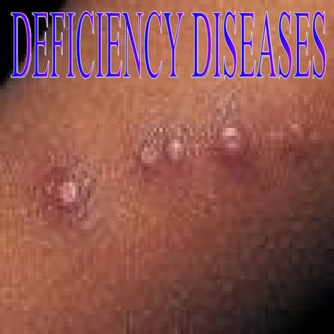 Deficiency diseases | PPT