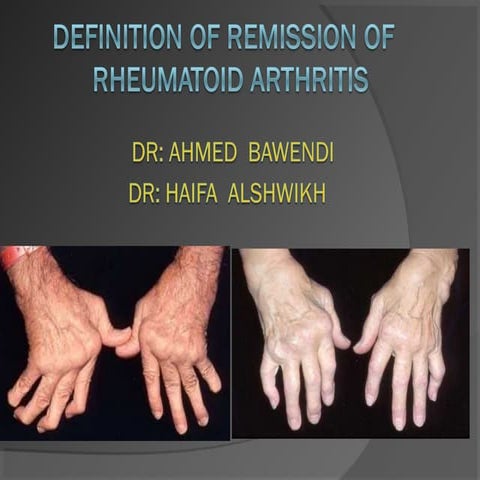 Definition of remission of ra | PPT