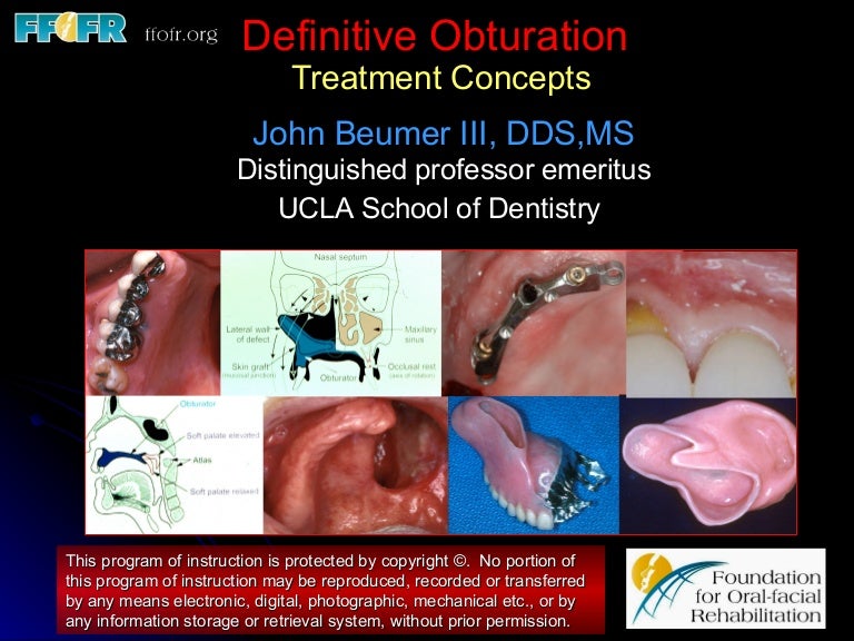 Definitive obturation treatment concepts