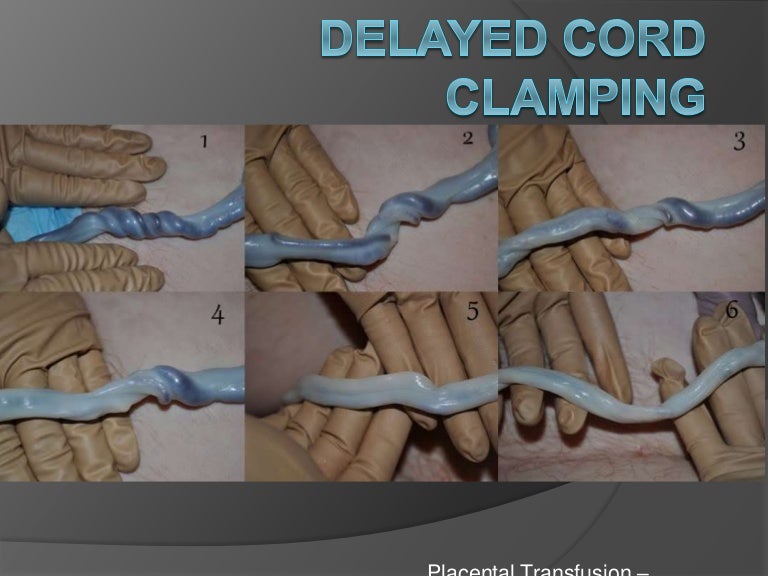 Delayed Cord Clamping