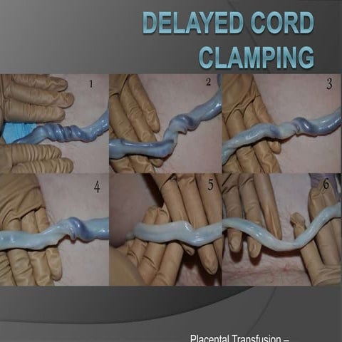 Delayed cord clamping