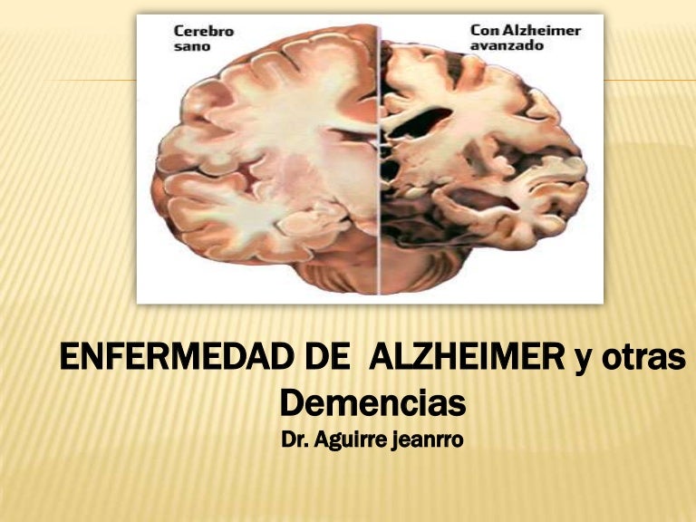 que tipo de enfermedad es alzheimer