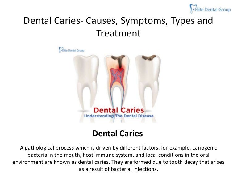 Dental cariescausessymptomstypestreatment