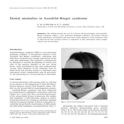 Dental anomalies in axenfeld rieger syndrome (1) | PDF
