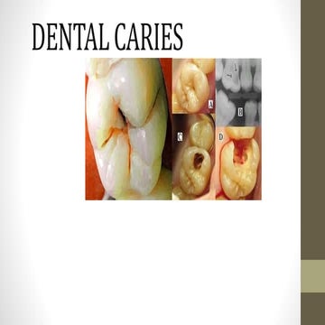 Dental caries- etiology clinical features histopathology and caries activity test