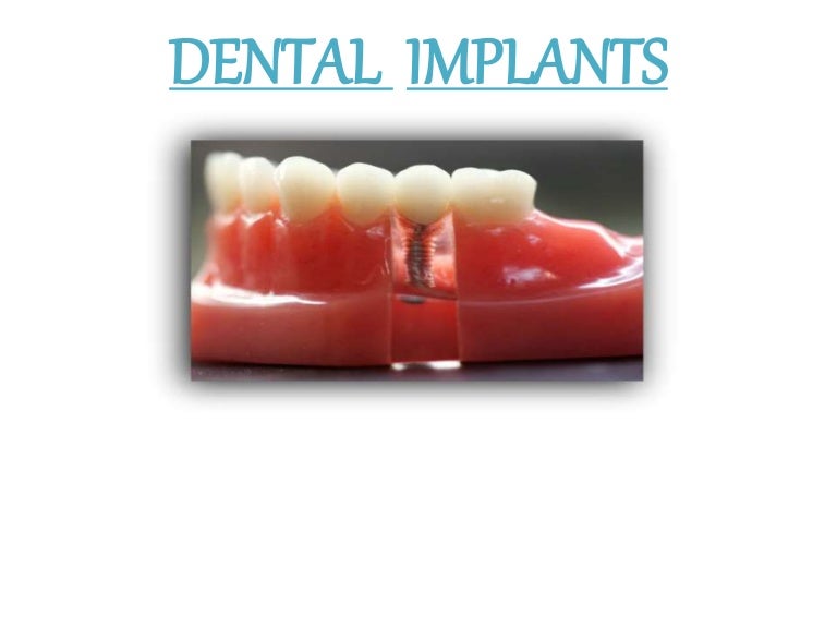 Dental implants