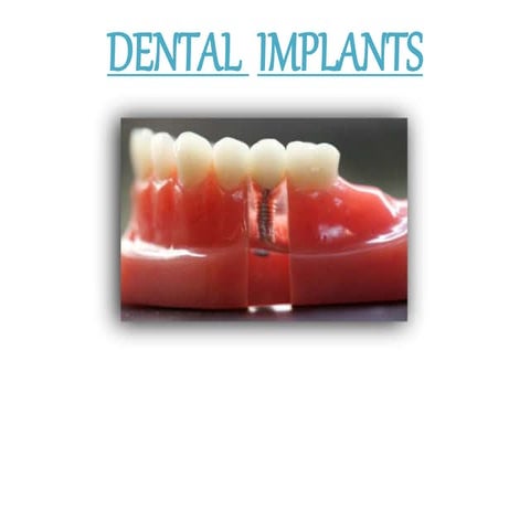 Dental implants