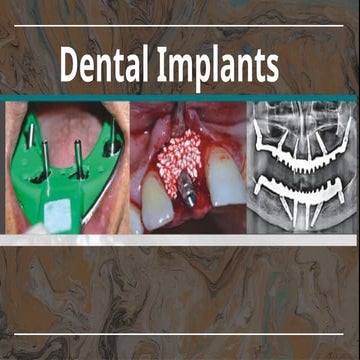 Basal implant - a newer variety of implant system | PPTX