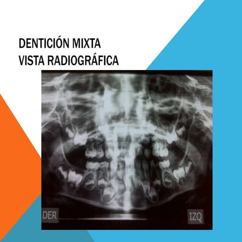 Dentición mixta | PPTX