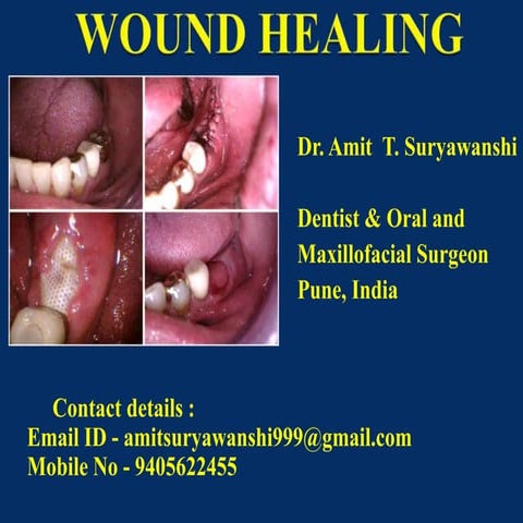 Dentist in pune.(BDS. MDS) - Dr. Amit T. Suryawanshi. Wound healing in Dentis...
